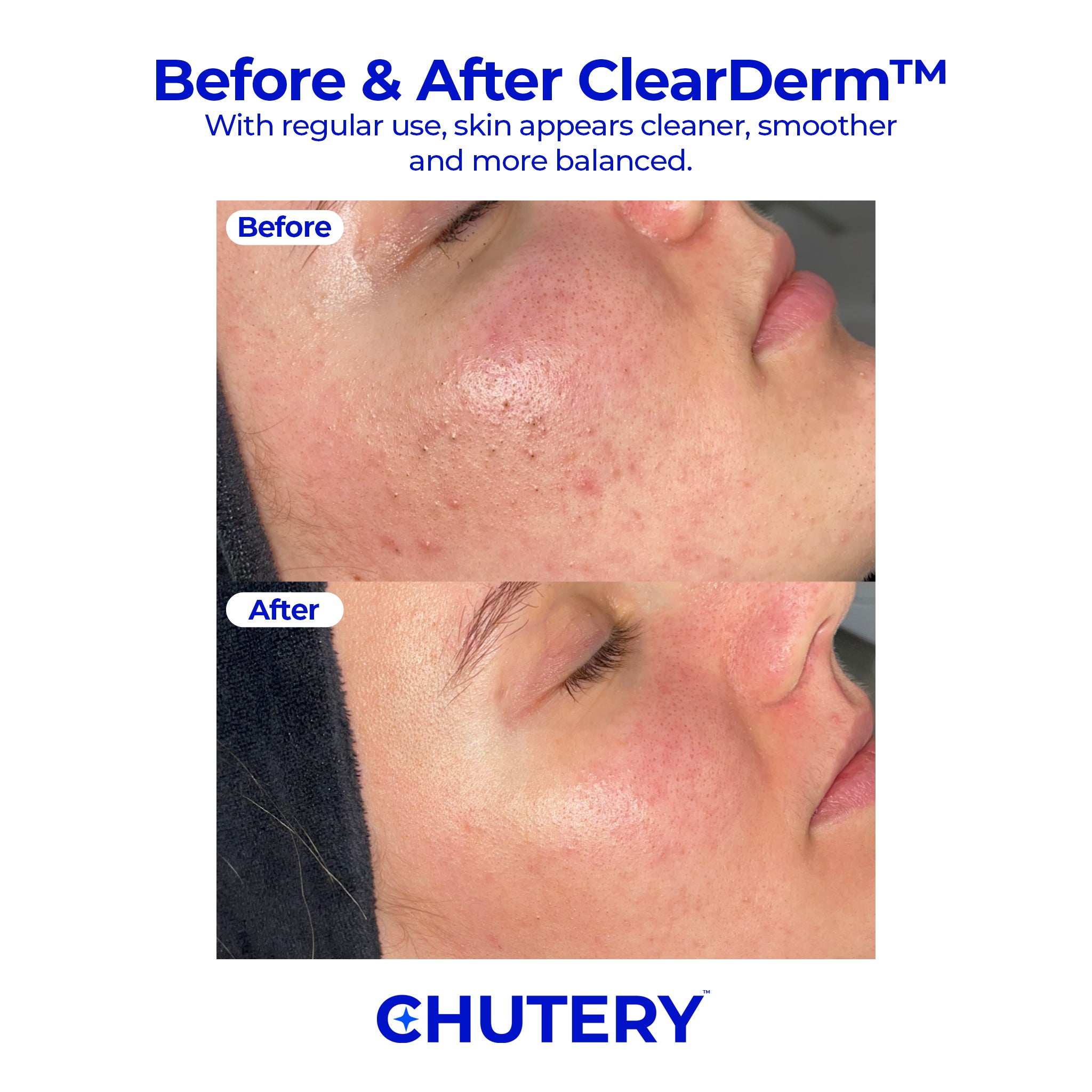 Chutery ClearDerm™ Sonic Cleanser